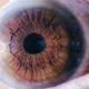Another (possible) example of a protruding iris collarette. (Image: Luizmeira)